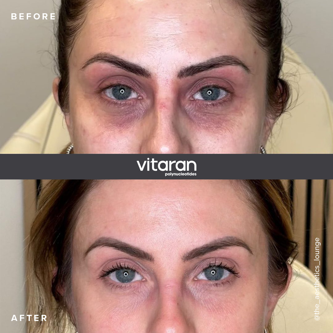 VITARAN before and after results