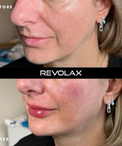 Alternative view of REVOLAX Deep With Lidocaine (1 x 1.1ml)