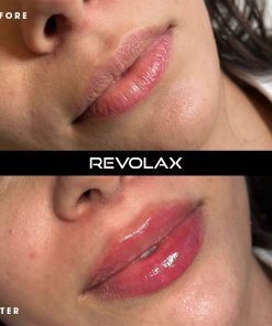 Alternative view of REVOLAX Fine With Lidocaine (1 x 1.1ml)