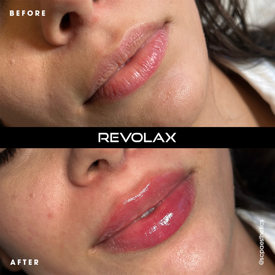 REVOLAX Fine With Lidocaine (1 x 1.1ml) - Image 2