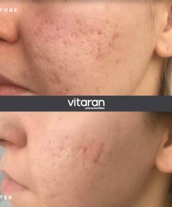 Alternative view of VITARAN II (2 x 2ml)