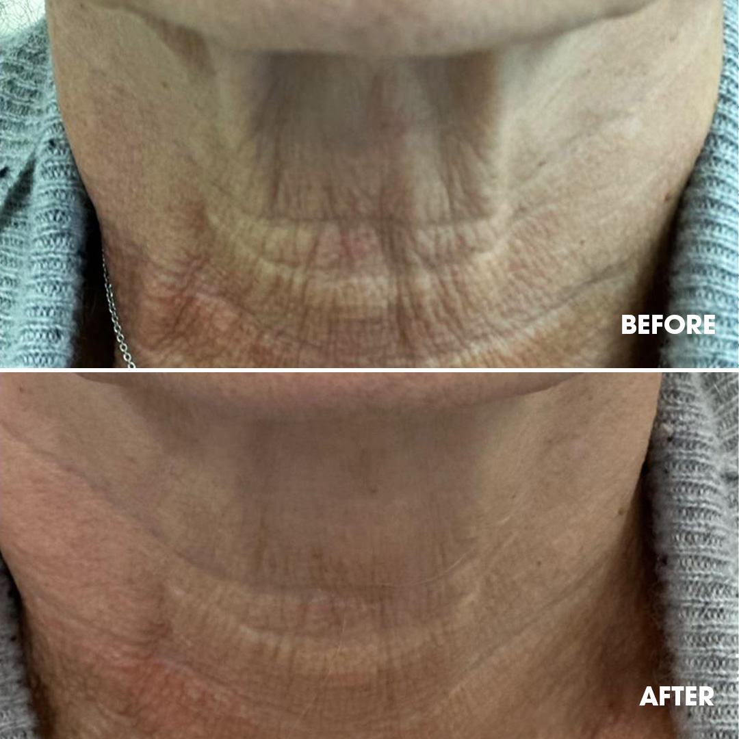 Jawline contouring before and after