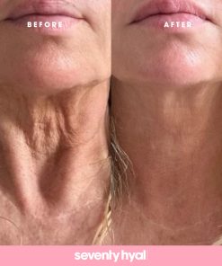 Alternative view of Seventy Hyal 2000 Single (1 x 2ml) + 2 Free Needles
