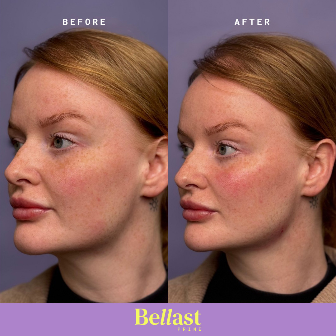 Bellast Prime Hard with Lidocaine (1 x 1ml) - Image 3