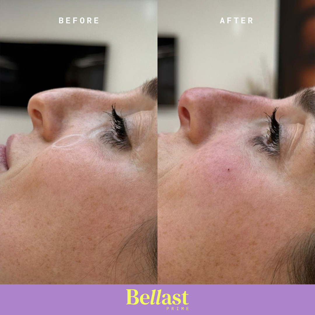 Bellast Prime Ultra with Lidocaine (1 x 1ml) - Image 3